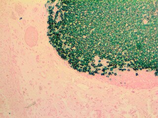 IHC of CD20 on an FFPE Colon Tissue